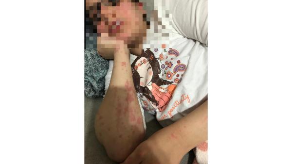 Eczacının otizmli Zeynep’e verdiği muadil ilaç alerjik etki yaptı; baba şikayetçi oldu Erol POLAT/ÇAYIROVA (Kocaeli), (DHA)- KOCAELİ’de, Necdet Taş (45), otizm nedeniyle