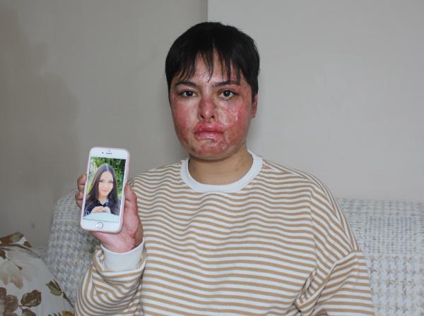 İş kazası nedeniyle vücudunun yüzde 80'i yanan Beyzanur: Eski ben değilim artık İş kazası nedeniyle vücudunun yüzde 80'i yanan Beyzanur: Eski ben değilim artık