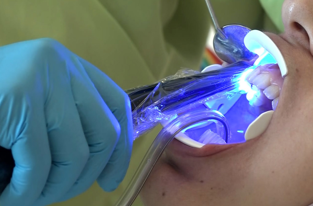 'Beyazlatma işleminde yanlış uygulama diş kaybına neden olabilir'