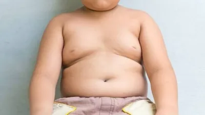 Dünya Sağlık Örgütü (DSÖ), çocuk ve ergenlerde obezitenin dünya genelinde